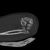 SPORK, NICO - 22.03.1976 - 02.08.2022 - CT obere Extremität - 18:02:23